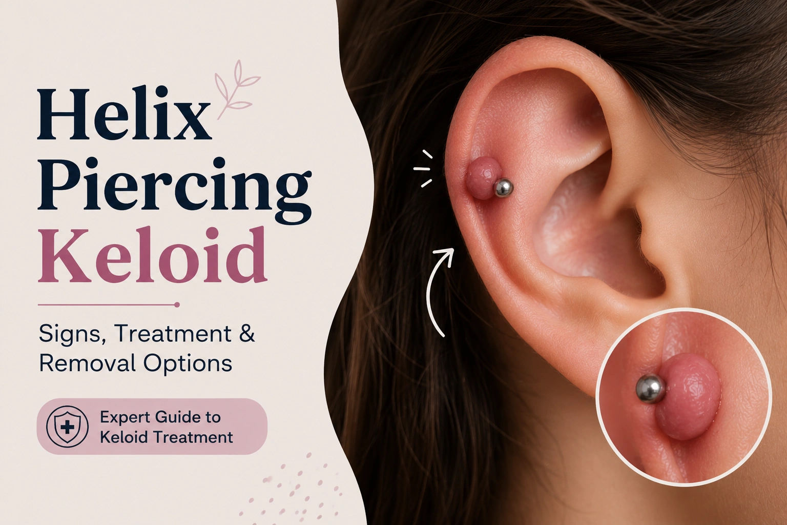 Helix Piercing Keloid 2 Helix piercing keloid